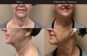 Morpheus8 on jowls before and after