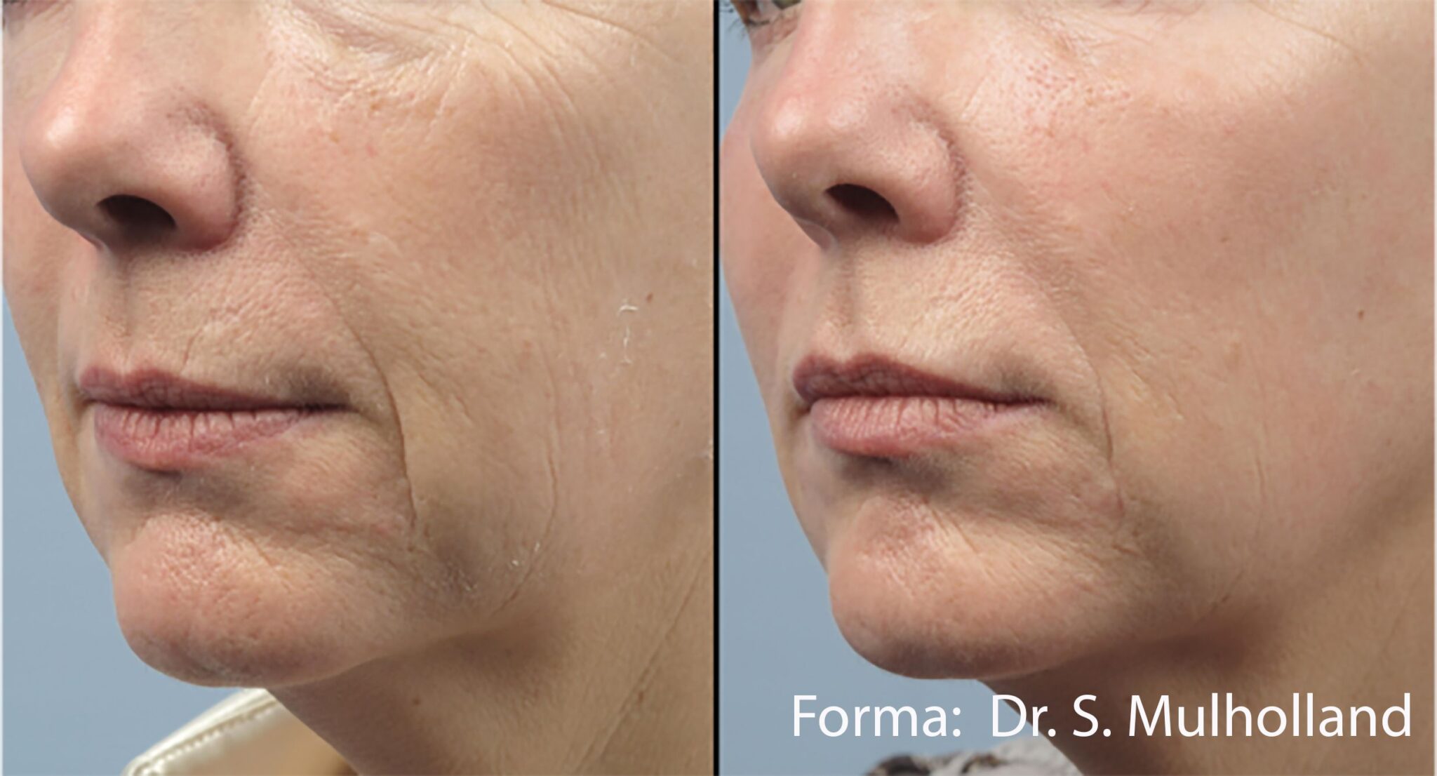 forma before after Dr.S.Mulholland 1