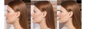 Kybella for Chin Contouring before and after