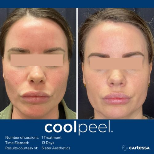 CPSlaterAestheticsfemalefacefront22_compressed-500x500