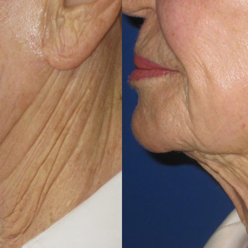 Forma Skin Tightening - Mirror Mirror Med Spa
