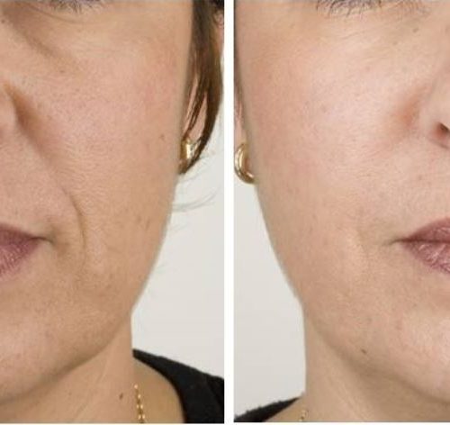 Injectable Facial Fillers Before and After Images