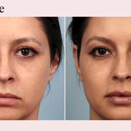 Injectable Facial Fillers Before and After Images