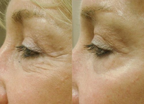 Cool Peel Laser Before and After Images