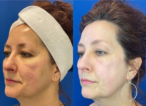 Cool Peel Laser Before and After Images