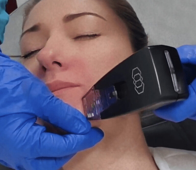 Benefits of fat and collagen resurfacing with Morpheus8