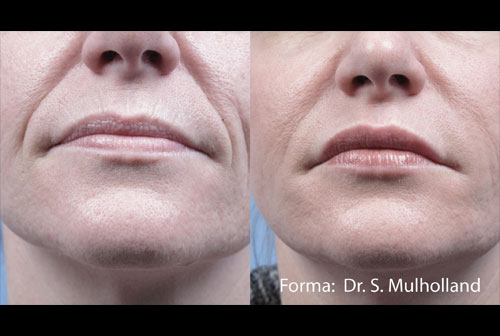 Before and after Image of a face after done with skin lifting