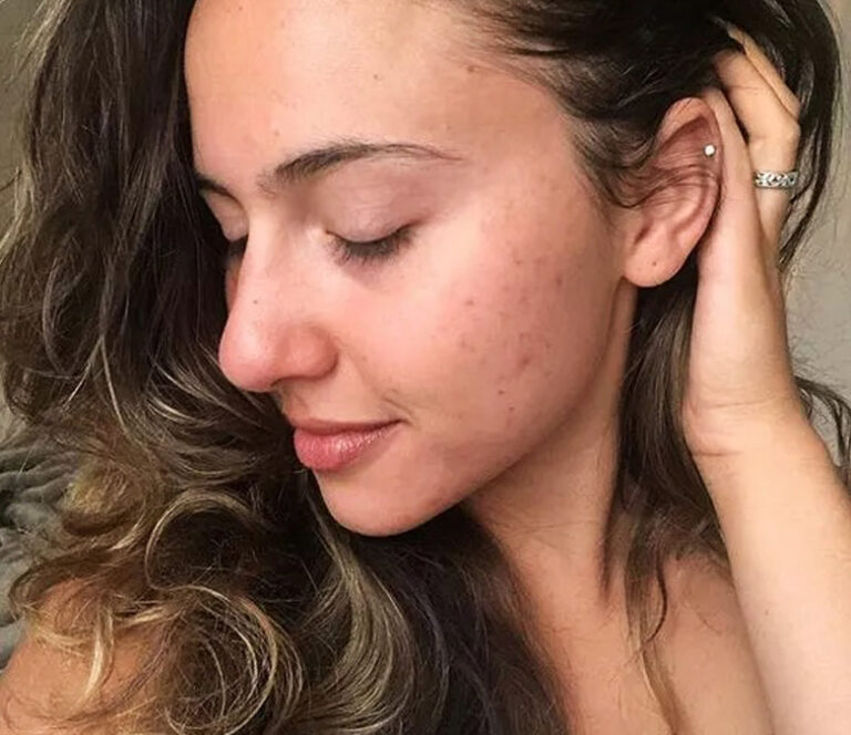 Laser Scar Removal Treatment in Beverly Hills Scar Revision