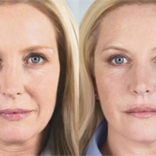 Injectable Facial Fillers Before and After Images