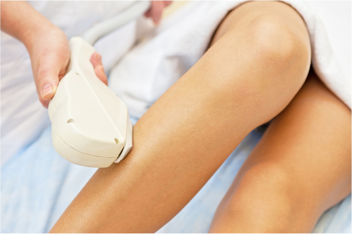 Laser hair removal