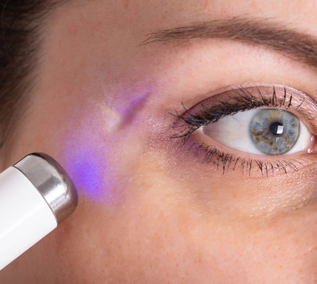laser scar treatment - treatments in your 20s