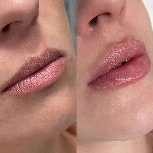 Before and after lip filler treatment results at Mirror Mirror Medspa Los Angeles