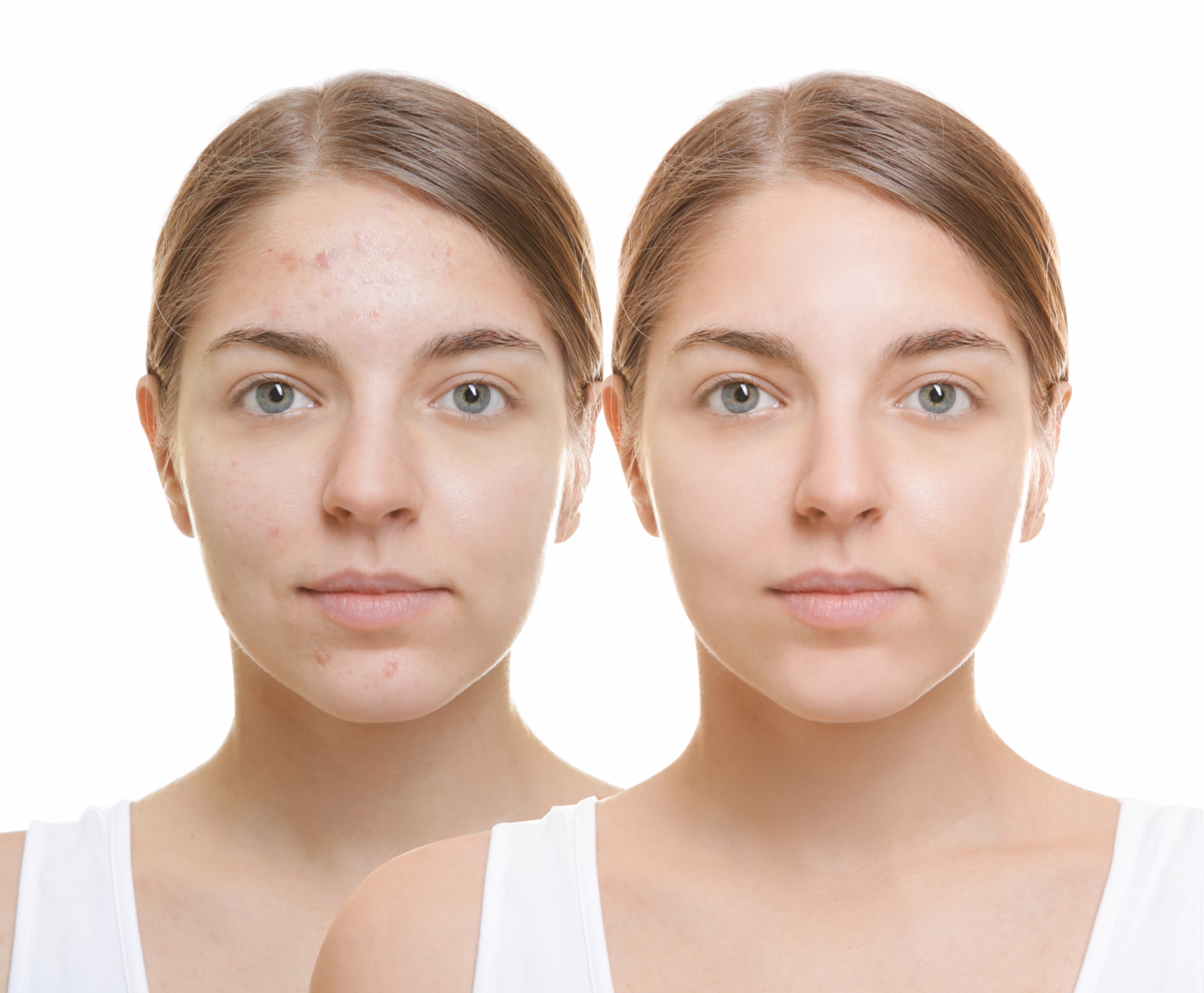 Breaking Out of the Cycle: Med Spa Solutions for Adult Acne