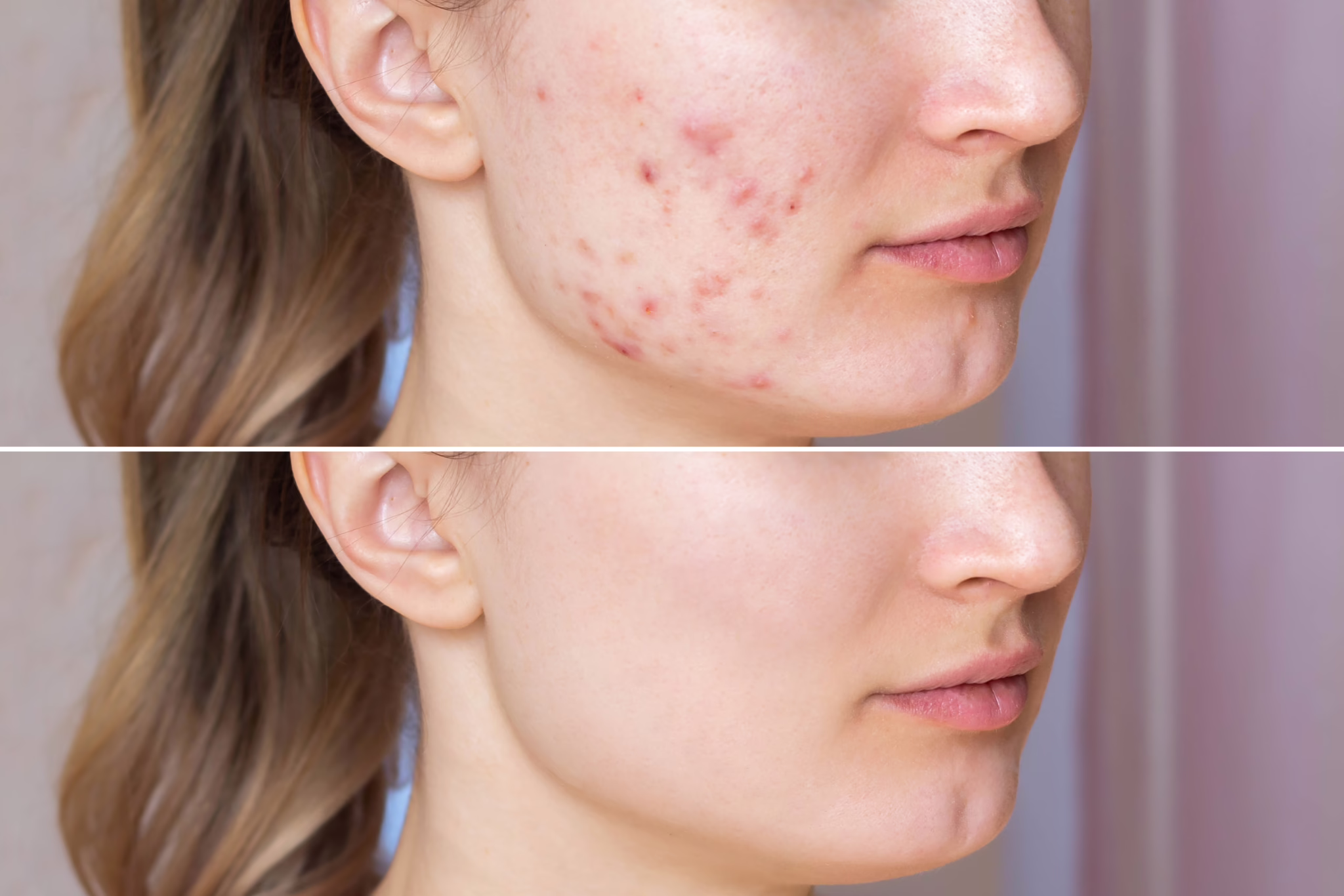 Breaking Out of the Cycle: Med Spa Solutions for Adult Acne