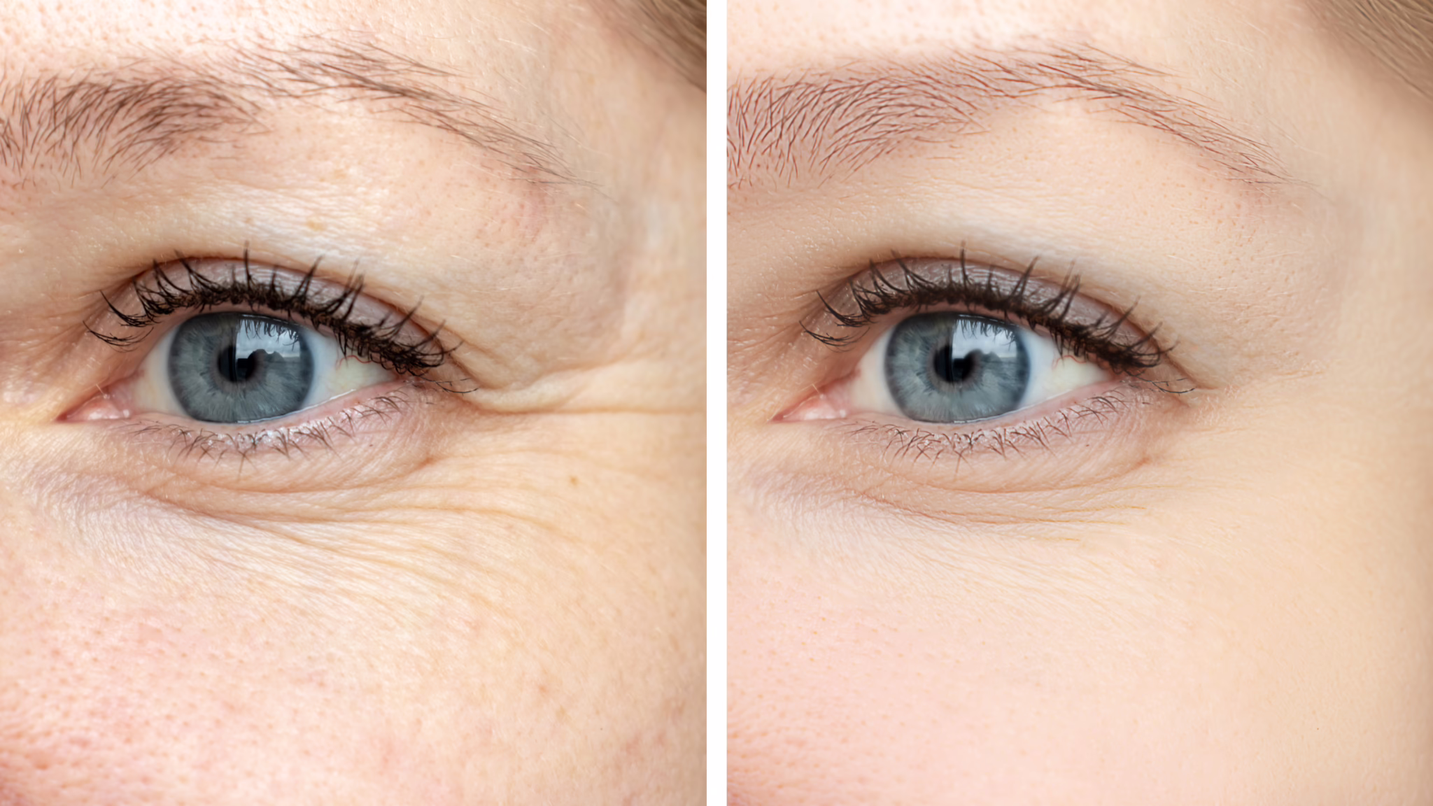 Before and after results of Botox vs. dermal fillers