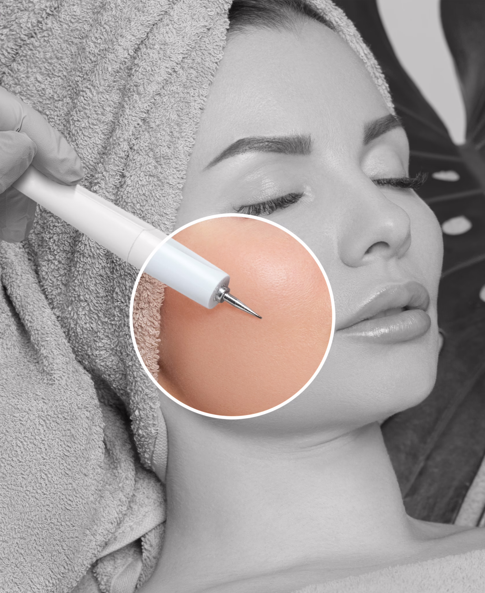 Non-invasive wart removal treatment in Los Angeles