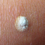 Skin tag and lesion treatment before and after
