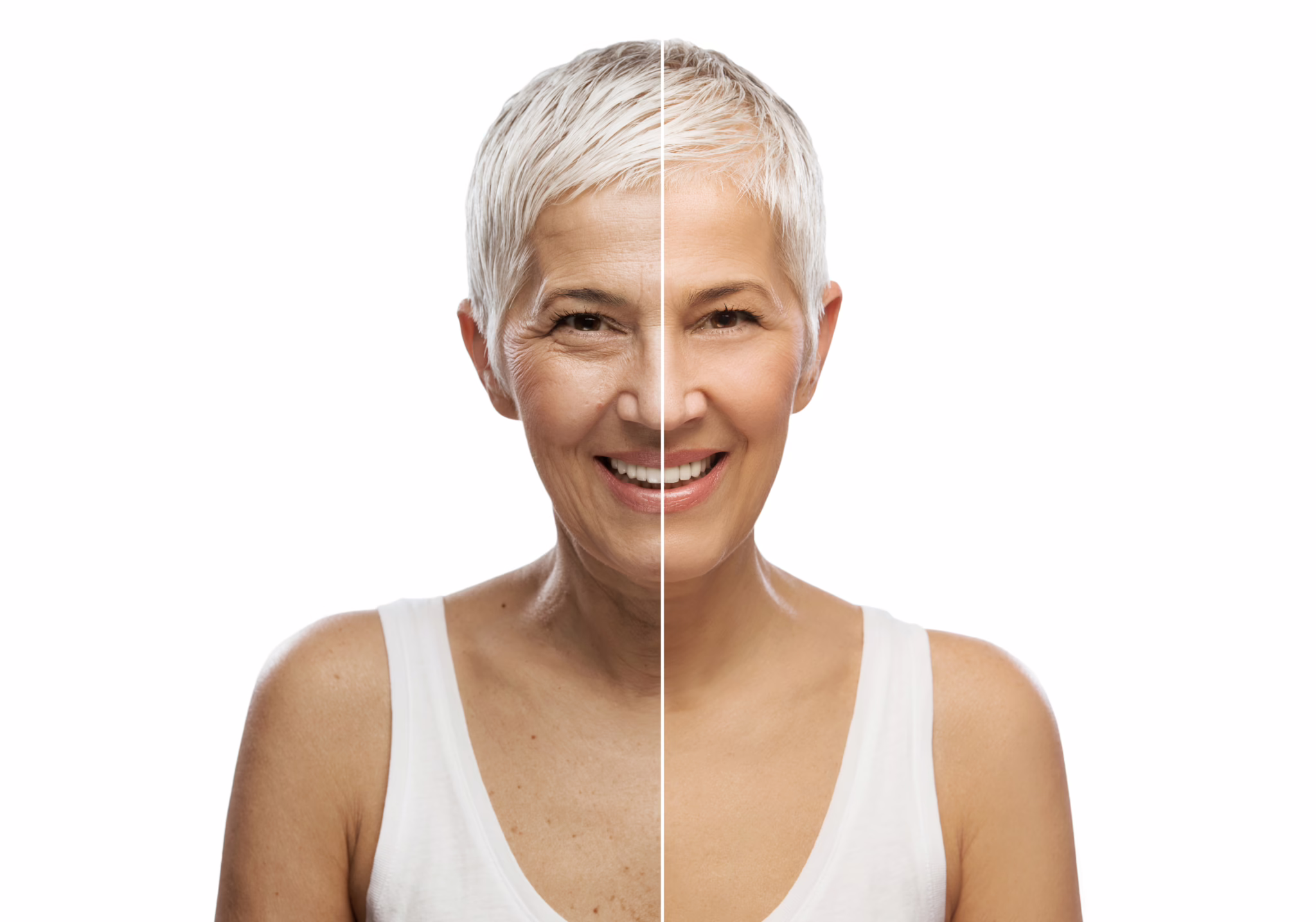 Botox after 50