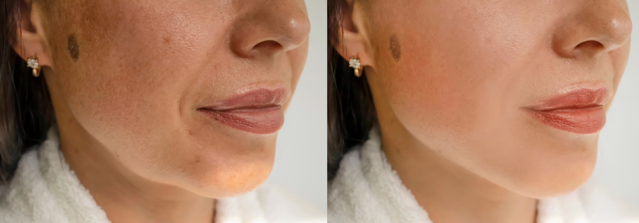Kybella in Los Angeles
