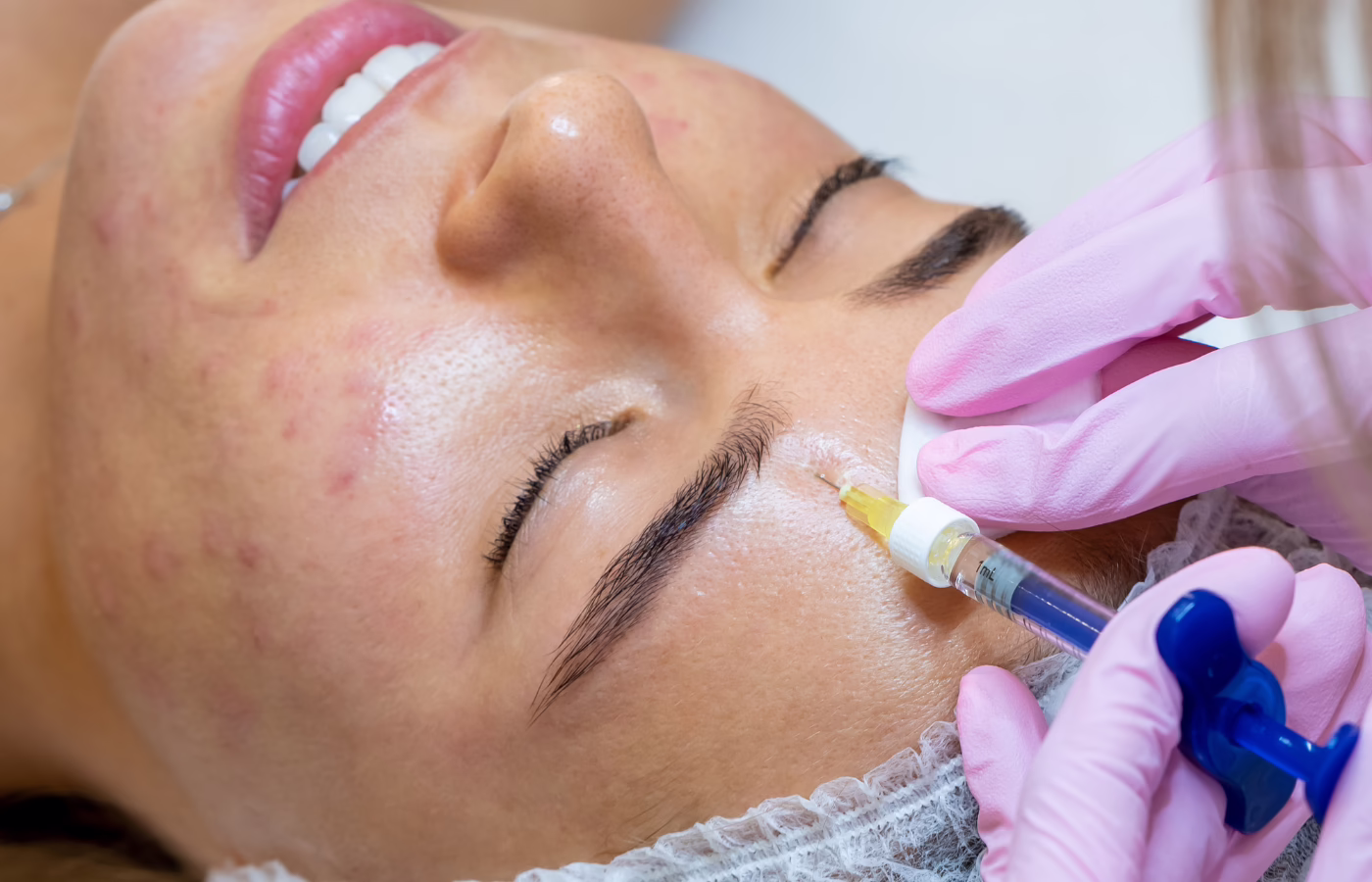 Cortisone Shot Acne LA