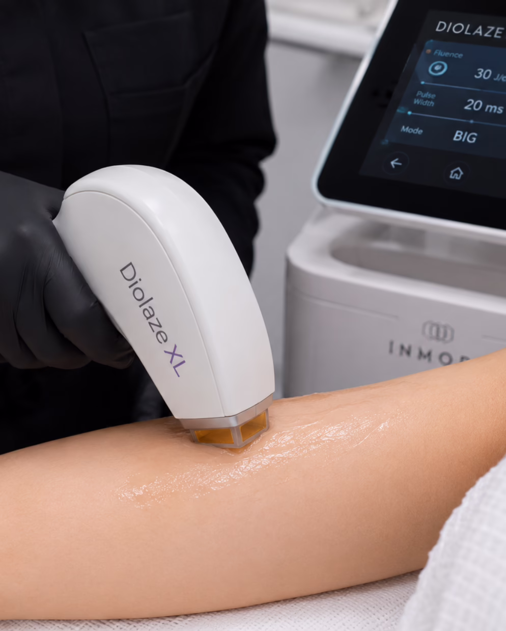 Diolaze XL laser hair removal treatment at Mirror Mirror Med Spa Los Angeles