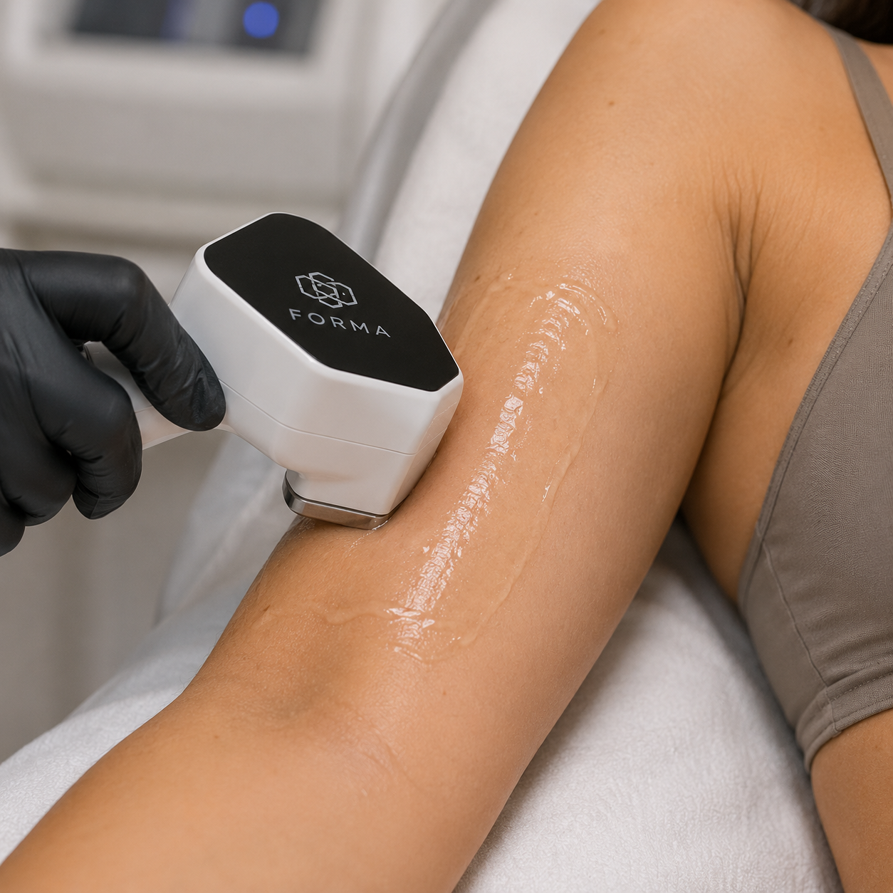 Forma radiofrequency handpiece on the abdomen