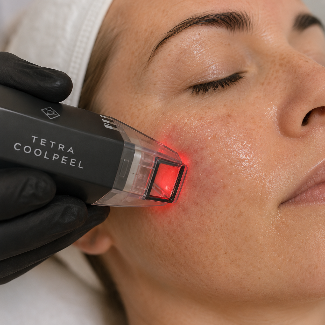 CoolPeel CO2 laser resurfacing for boxcar scars