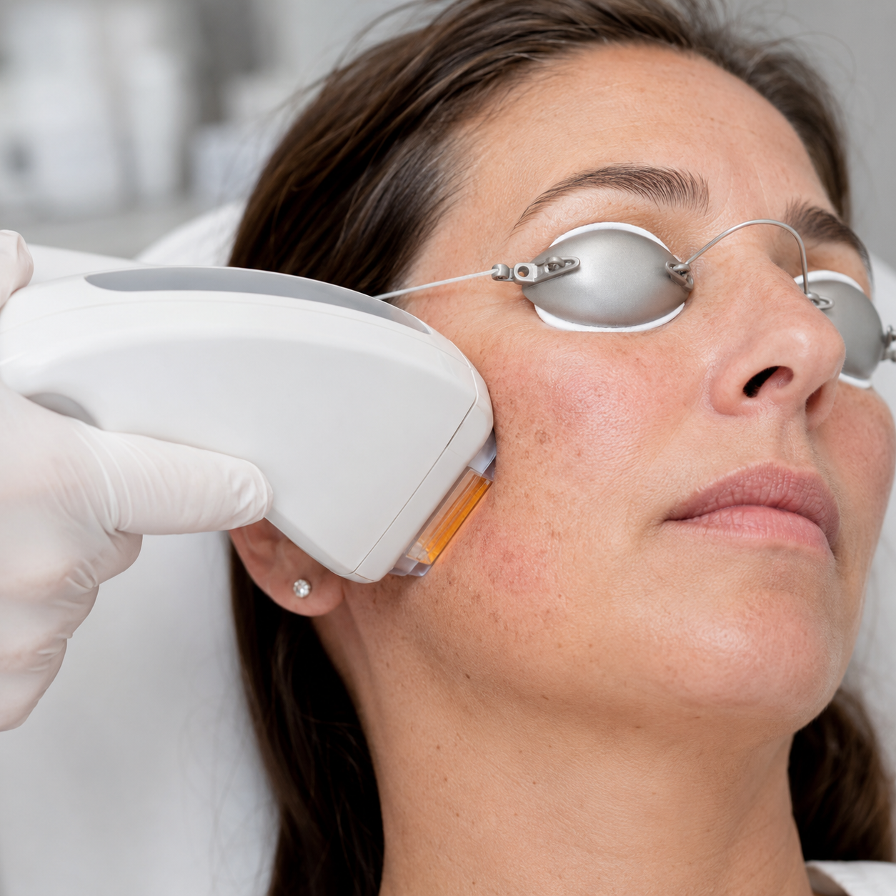 Lumecca IPL for red and brown post-acne marks