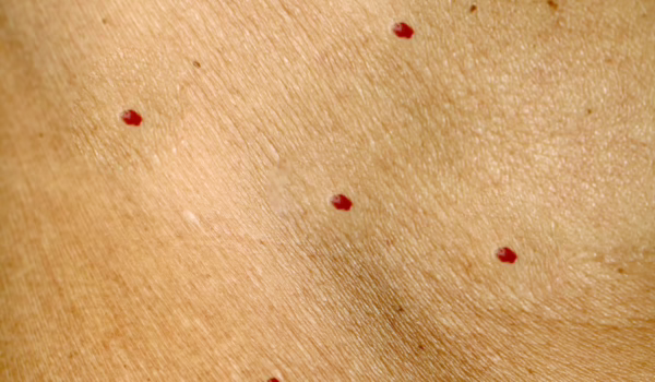 Angioma on the skin. Red moles on the body. Many birthmarks. Angioma on the skin. Red moles on the body. Many birthmarks
